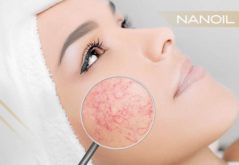 Couperose Skin: Symptoms, Treatments, Beauty Products