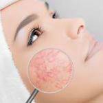 Couperose Skin: Symptoms, Treatments, Beauty Products